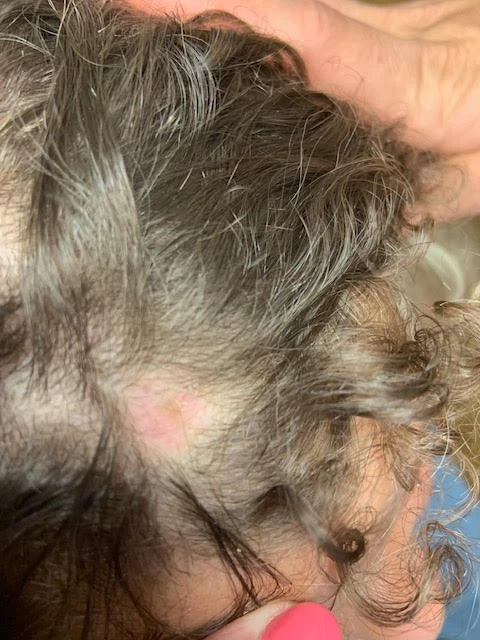 Alopecia Areata Specialist Sussex