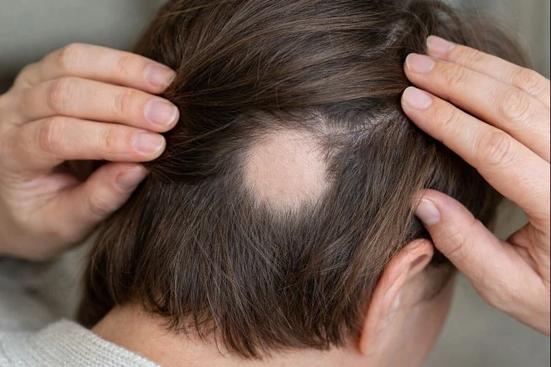 Alopecia Areata Treatment Sussex