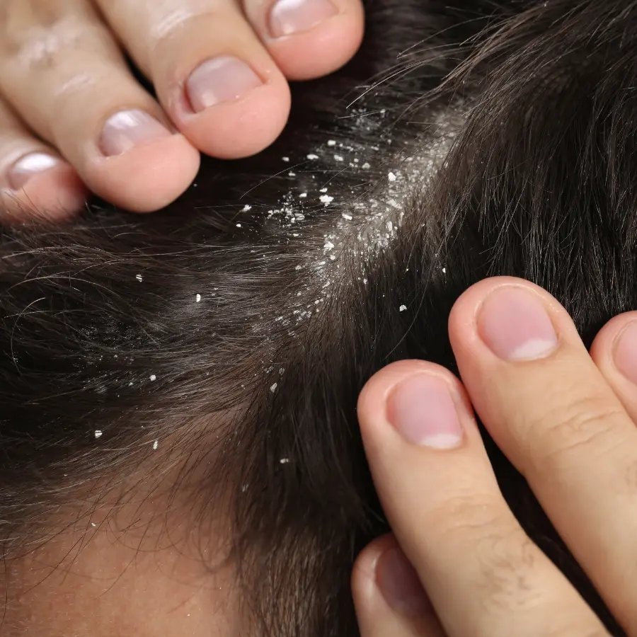Dandruff Treatment in Sussex