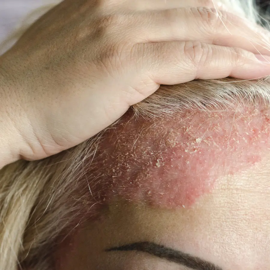 Scalp Psoriasis treatment in Sussex