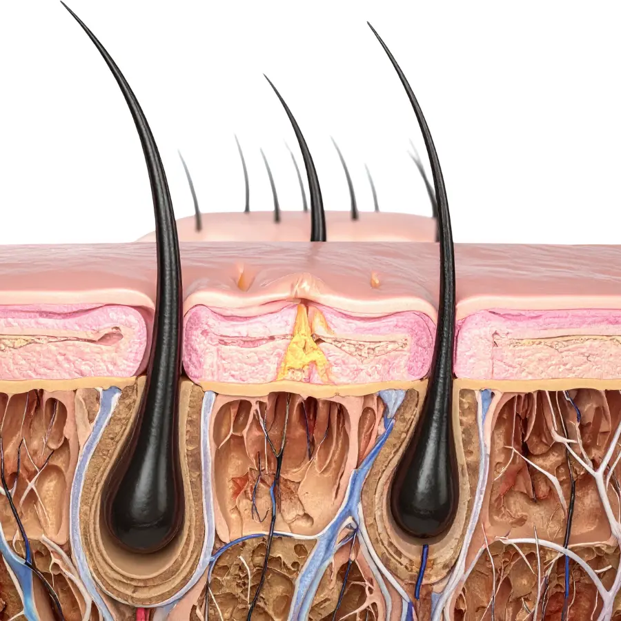 Seborrhoeic Dermatitis