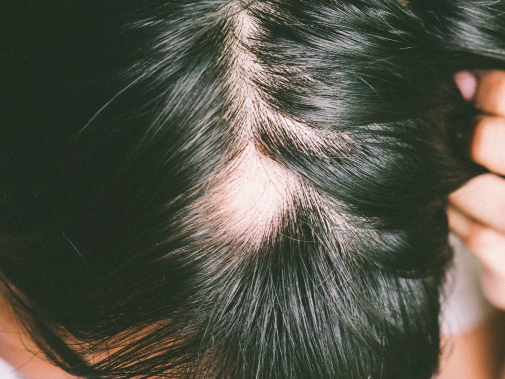 Traction-Alopecia-Treatment-Sussex